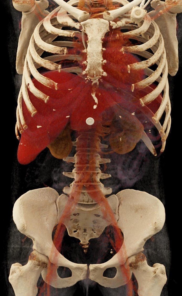 3D-rekonstruktion av datortomografi-bilder.